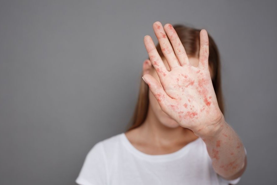 A young girl with measles on her hands and neck holds her hand over her face.
