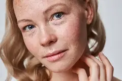 A women's face with freckles.