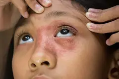 A young girl with a redness and dryness around her eye.