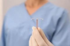 A doctor holding a copper IUD.
